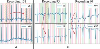 Generalising electrocardiogram detection and delineation: training convolutional neural networks with synthetic data augmentation